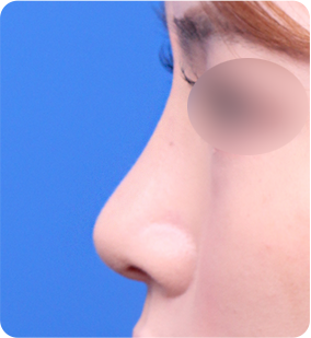 낮은코 성형 수술 후