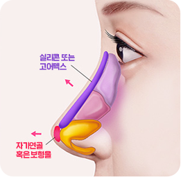 낮은코 성형 