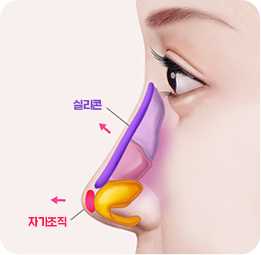 매부리코 성형 매부리 제거 및 콧대 높이기