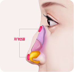 매부리코 성형 자가연골 삽입