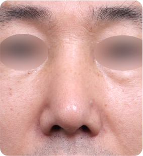 휜코 성형 수술 후