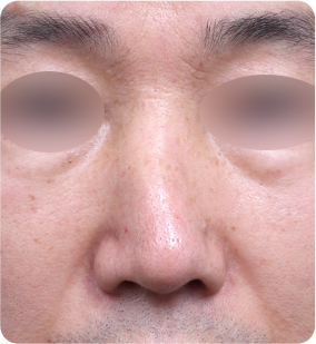 휜코 성형 수술 전
