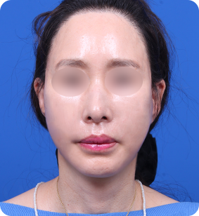 안면거상 정면 후