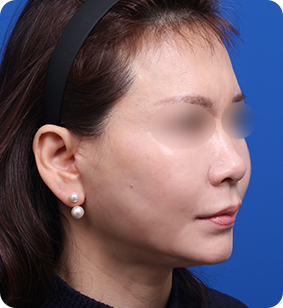 세미거상 측면 후