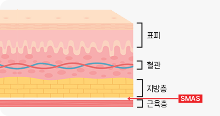 스마스층 박리