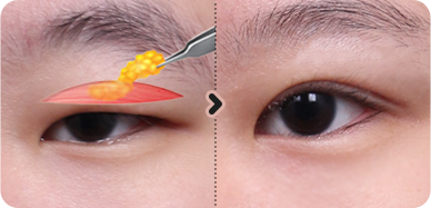 절개 눈매교정 전후